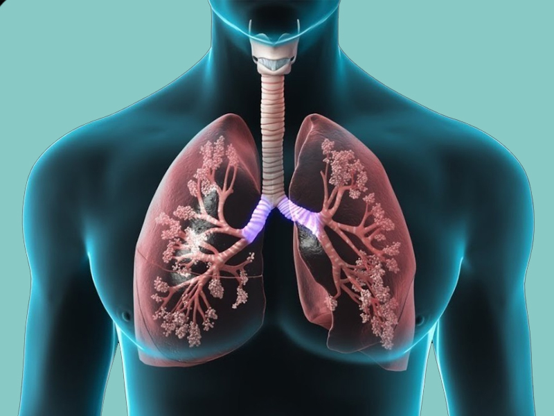Мікоз легень: причини, симптоми та лікування